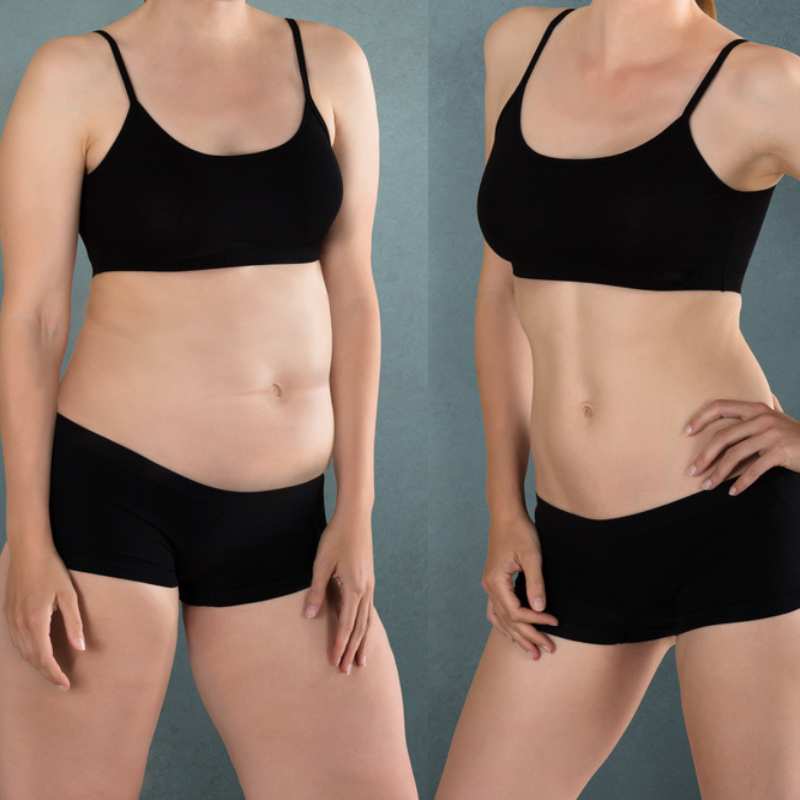 Does Fat Freezing at Home Work? DIY Devices vs Professional Cryolipolysis 2 before and after Cryolipolysis Birkdale