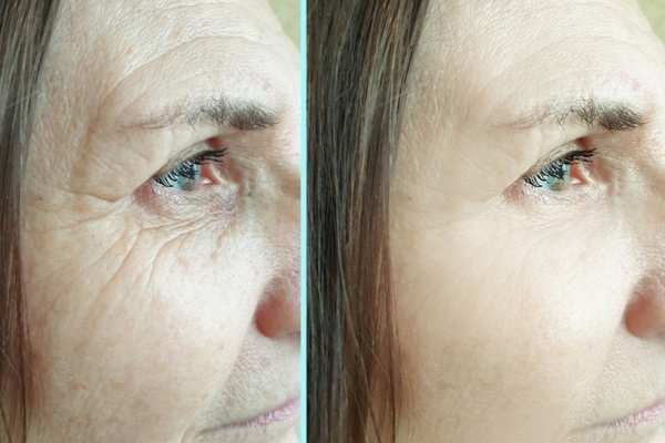 Why Do People Choose HIFU for a Non-Surgical Facelift? 4 How long can HIFU results last Birkdale?