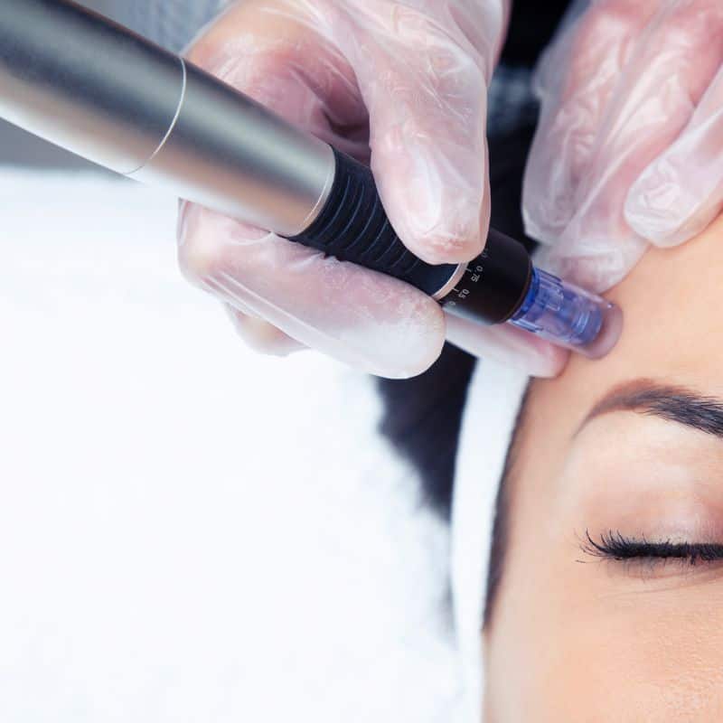Morpheus8 treatment Birkdale from Lipo Sculpt - Book in today!